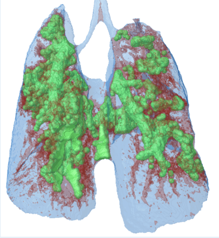 Mouse lung, tumor tissue in green